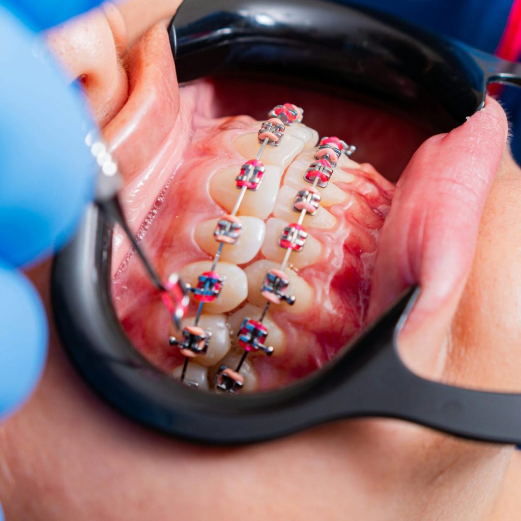 Close-up of dental braces being examined by dentist using tools with gloves.