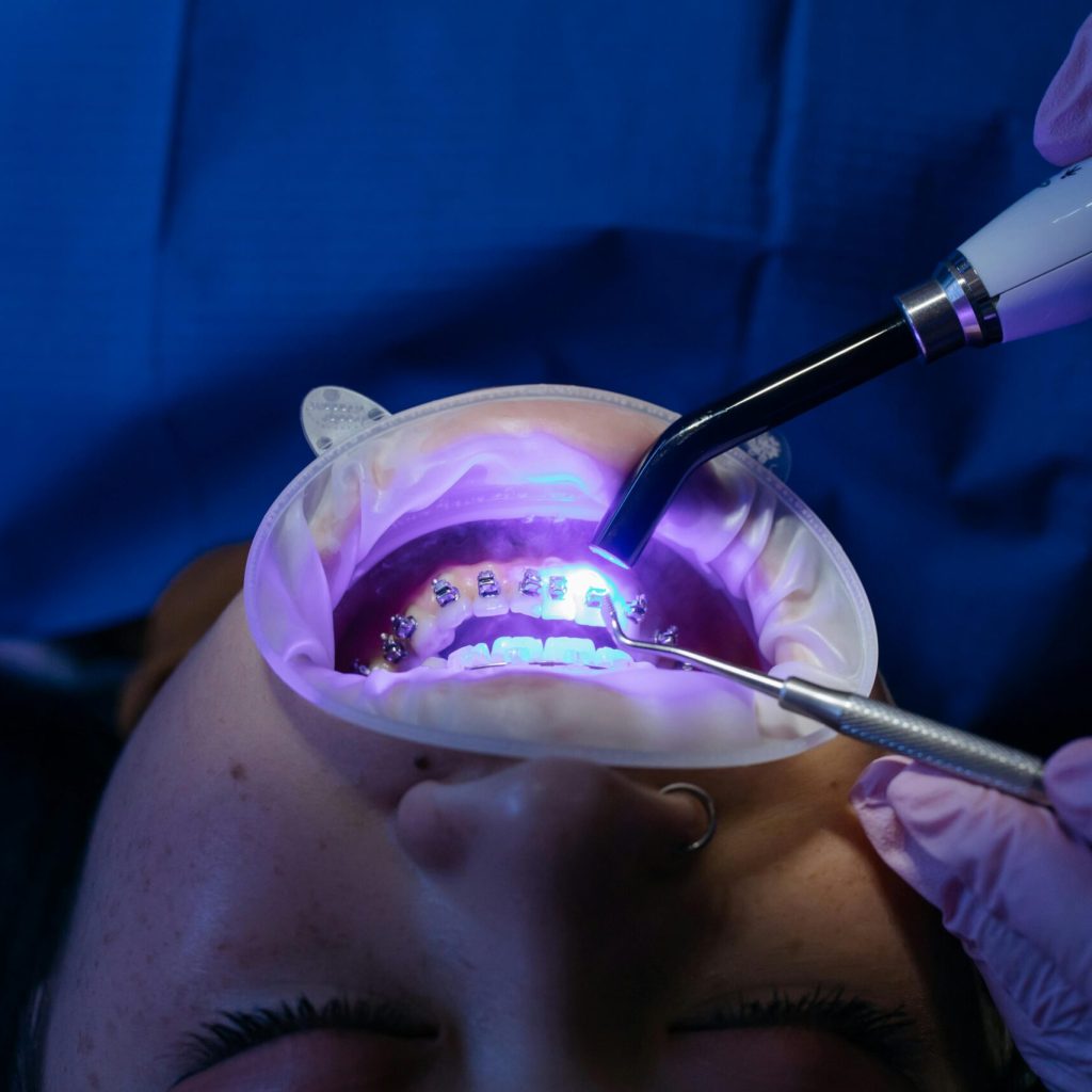 UV light curing dental procedure for teeth whitening and health care.